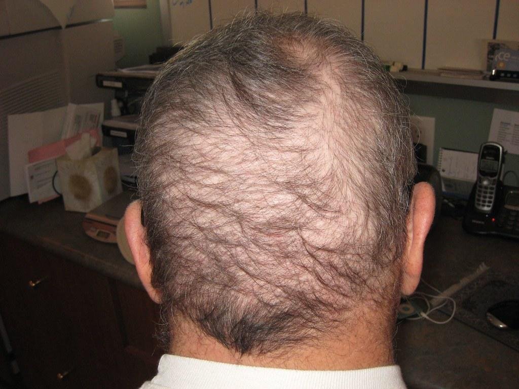 1. Understanding the Latest Innovations in Hair Transplantation: From FUT to FUE‌ Techniques