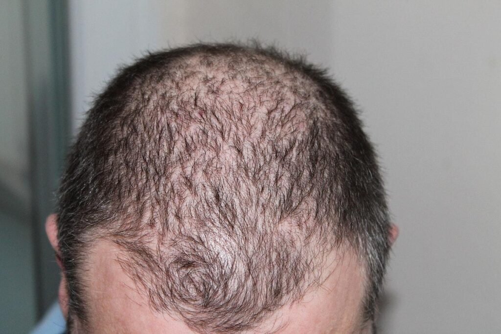 Growing Confidence: The Psychological Benefits of Hair Transplantation